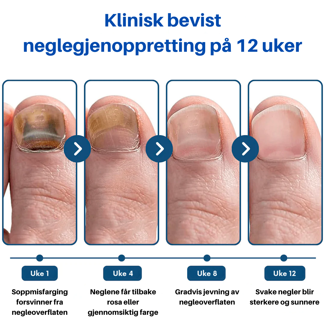OnyClear™- Laser mot neglesopp